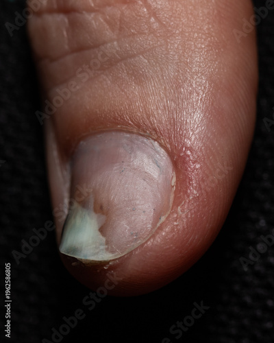 Close-up of chipped fingernail with minor damage and discoloration, ideal for healthcare, dermatology, and nail care content highlighting fragility, injury, and everyday nail problems