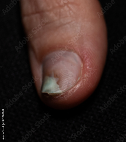 Close-up of chipped fingernail with minor damage and discoloration, ideal for healthcare, dermatology, and nail care content highlighting fragility, injury, and everyday nail problems