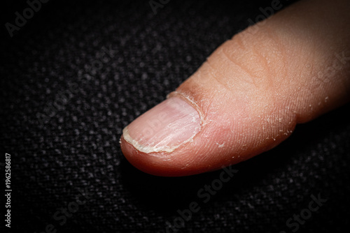 Close-up of dry and brittle fingernail with visible peeling, ideal for beauty, healthcare, and dermatology content about nail fragility, damage, and daily care routines