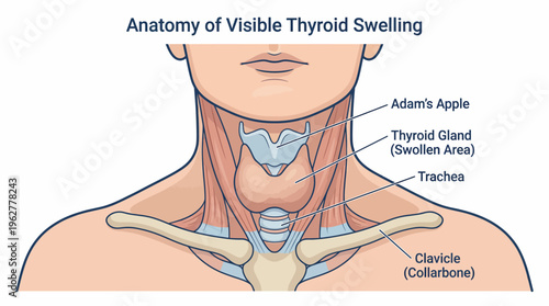 Human neck anatomy showing the thyroid gland and visible swelling