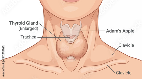 Enlarged thyroid gland in human neck anatomy with labeled trachea and Adam's apple