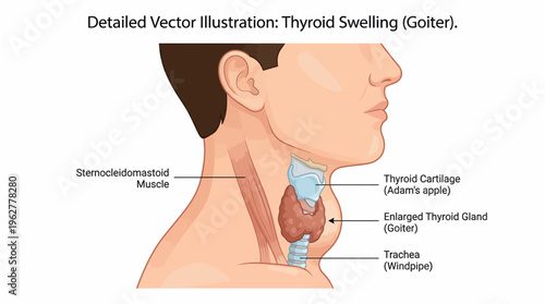 Detailed illustration of thyroid swelling condition known as goiter in human neck