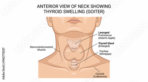 Goiter causes thyroid gland swelling in human neck anatomy