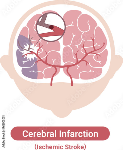 Ischemic stroke brain infarction medical illustration(English Labels)