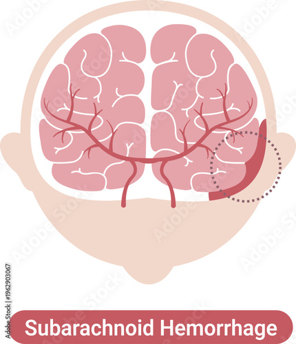 Subarachnoid hemorrhage medical illustration brain bleeding diagram(English Labels)