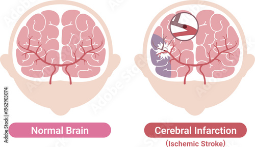 Ischemic stroke brain infarction comparison with normal brain medical illustration(English Labels)