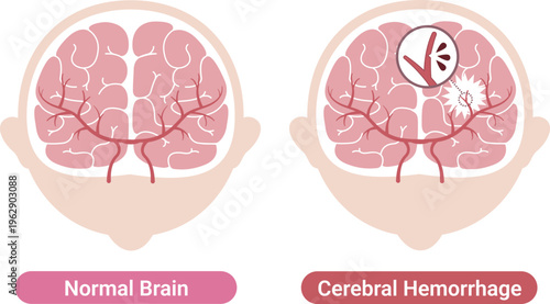 Cerebral hemorrhage comparison with normal brain medical illustration(English Labels)