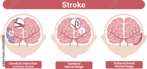 Stroke types brain infarction cerebral hemorrhage subarachnoid hemorrhage medical illustration(English Labels)