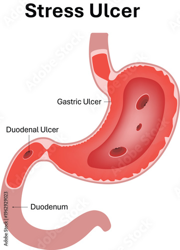 Stress Ulcer in Stomach and Duodenum Medical Illustration