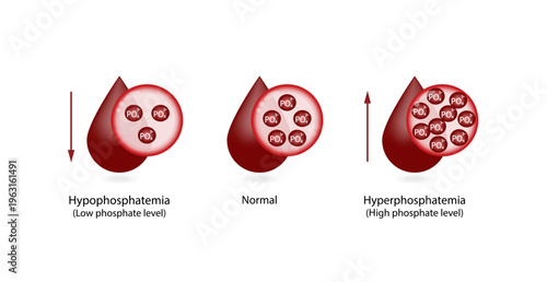Hyperphosphatemia, high plasma phosphate level and Hypophosphatemia, low plasma phosphate level. phosphate excess and deficit electrolyte disorders, blood droplet, Scientific Vector illustration.