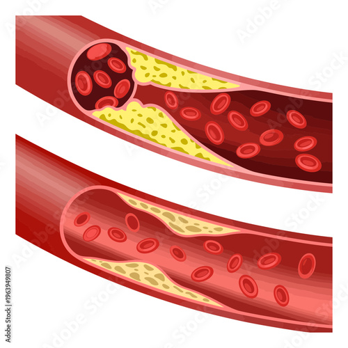 Of Atherosclerosis: Plaque Buildup in Arteries with Red Cells