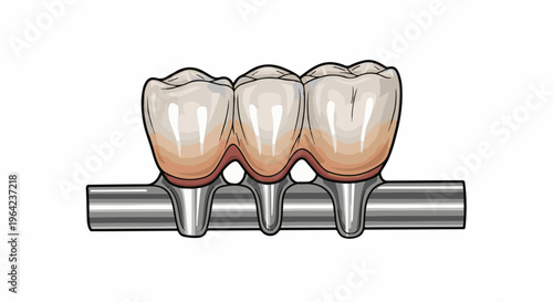 Illustration of a dental bridge, showing three artificial teeth supported by metal posts