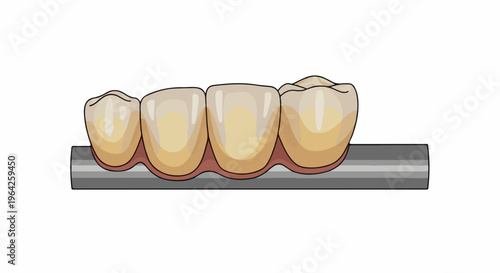 Dental bridge with four artificial teeth on a metallic support