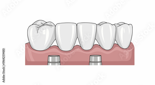 Dental implants supporting a bridge of replacement teeth