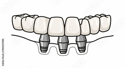 Dental implants and crowns shown in a cross-section of the gum
