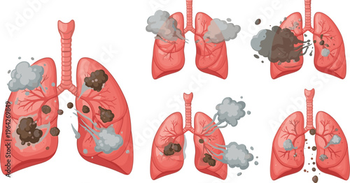Lung Damage from Pollution, Illustrating Smoke and Toxic Particles Affecting Respiratory Health