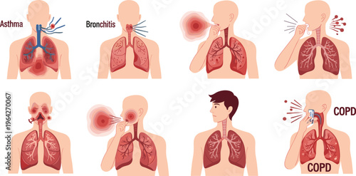Asthma, Bronchitis, and COPD Respiratory Diseases Illustration Showing Affected Lungs and Breathing Symptoms
