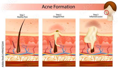 Acne Formation Process Medical Illustration Skin Layers Pore Blockage Sebum Inflammation Diagram. Step by Step Acne Development Infographic Healthy Pore Clogged Pore Swollen Pore Skin Anatomy
