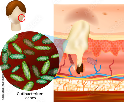 Cutibacterium Acnes Bacteria in Skin Pore Medical Illustration Acne Formation. Acne development in human skin with a cross section of a hair follicle and sebaceous gland. 