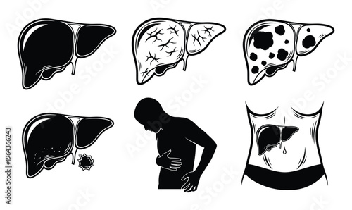 Liver disease stages vector illustration, healthy, cirrhosis, cancer and organ failure, human body diagram