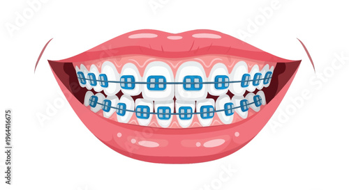 Illustration of a smiling mouth with blue braces on teeth against a white background