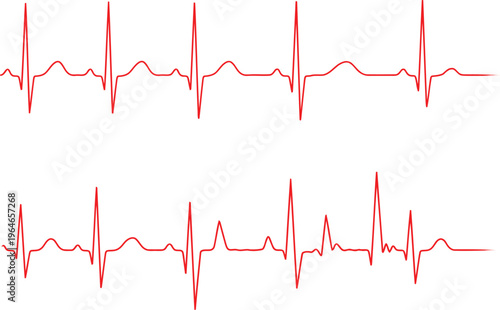A comparison of a normal sinus heart rhythm and an irregular heartbeat on an electrocardiogram. Vector