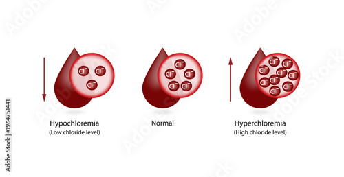 Hyperchloremia, high plasma chloride level and Hypochloremia, low plasma chloride level. Chloride excess and deficit electrolyte disorders, blood droplet, Scientific design. Vector illustration.