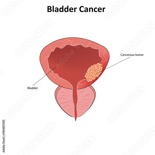 Bladder cancer vector illustrration
