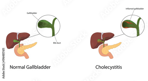 Cholecystitis vector illustration