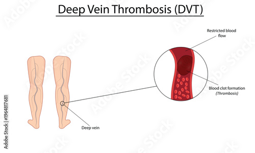 Deep vein thrombosis vector illustration