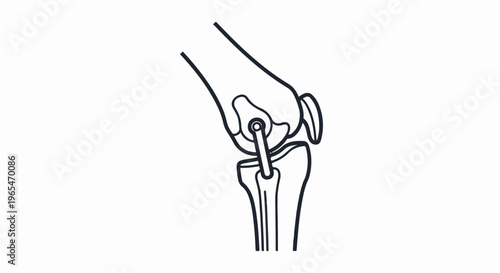 Stylized black and white diagram of a knee joint replacement