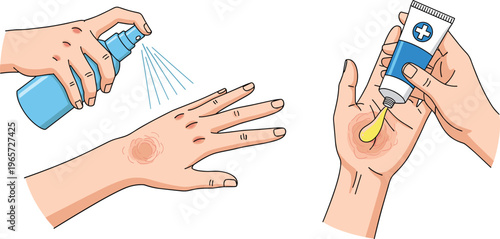 First aid skin care illustration showing hand wound treatment with antiseptic spray and healing ointment, medical hygiene and injury care concept, flat vector illustration