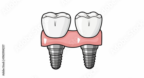 Two artificial teeth attached to implants, illustrating dental restoration