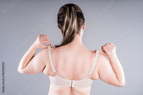 Canvas Print Rear view of plus size woman pulling tight bra straps showing red marks on skin,