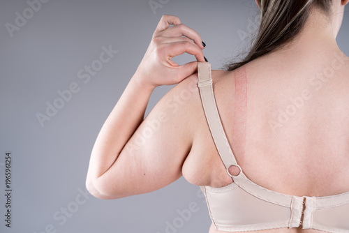 Tableau sur toile Rear view of plus size woman pulling tight bra straps showing red marks on skin,