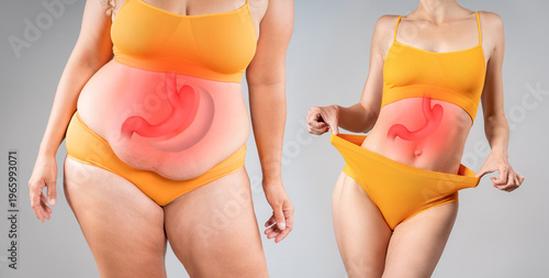 Before after weight loss transformation with bariatric surgery or gastric bypass. Overweight and slim woman with red stomach