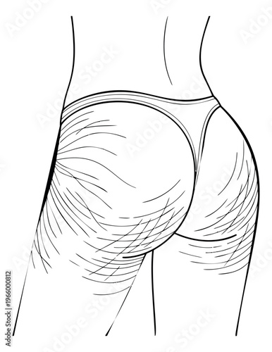 Engraving style illustration of female buttocks depicting cellulite and skin texture for beauty and medical design