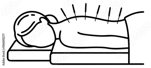Outline illustration of acupuncture treatment depicting patient lying with needles on back for healthcare and wellness design