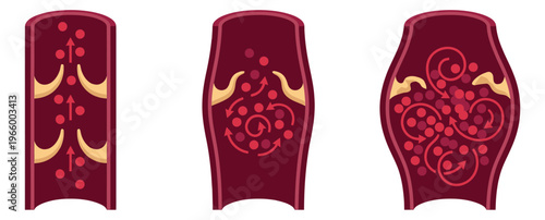 Flat illustration of artery blood flow stages depicting normal laminar flow turbulent flow and atherosclerosis progression for medical design