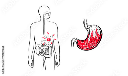 Gastroesophageal reflux pain