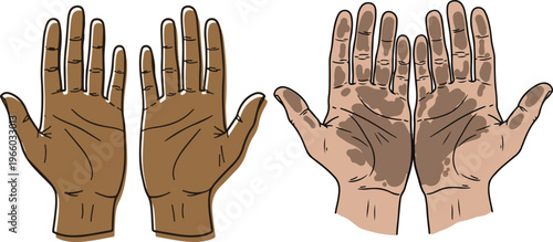 Vitiligo skin condition on human hands vector, medical illustration of depigmentation and pigment loss, dermatology health concept art
