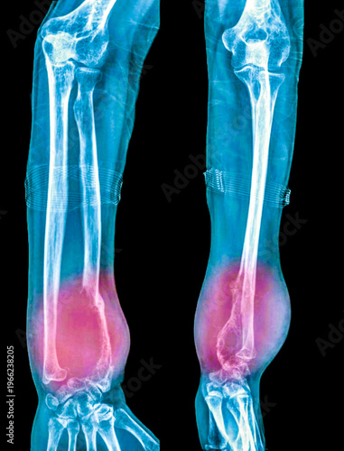 Bone cancer of the radius  X-ray
X-ray of the  patient  hand  with an aggressive bone tumour. The radius bone  contains lytic lesions,sugestive agresive bone tumour 
