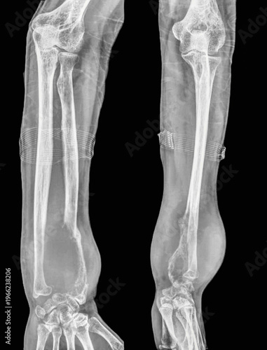 Bone cancer of the radius  X-ray
X-ray of the  patient  hand  with an aggressive bone tumour. The radius bone  contains lytic lesions,sugestive agresive bone tumour 
