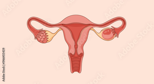 Medical illustration of the female reproductive system showing a healthy uterus and ovaries with one ovary containing a large cyst.