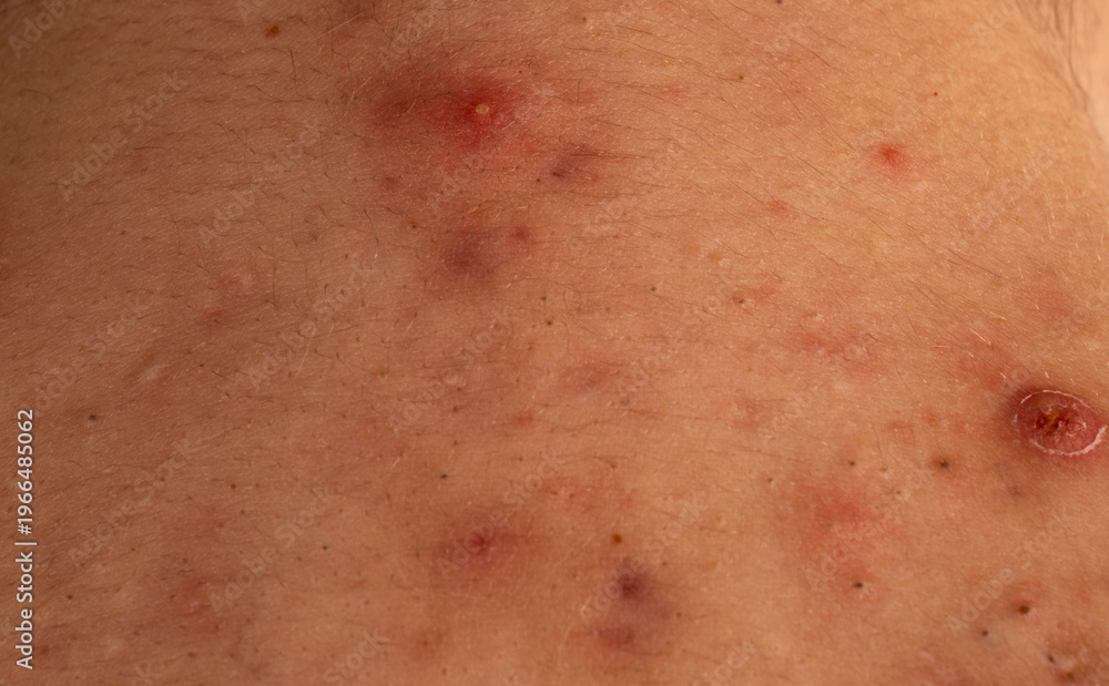 Fototapeta premium Pimple macro close up for skincare texture detail. Pimple close up pores and sebum on skin. Pimple acne macro with whitehead comedone and blemish. Pimple macro for dermatology background.