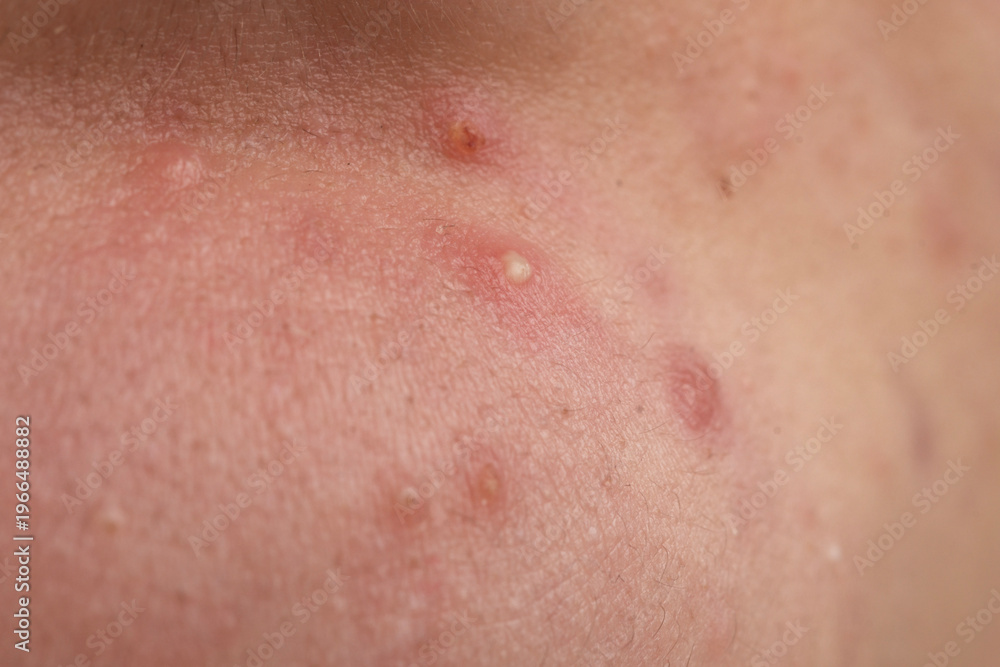 Fototapeta premium Pimple on human skin with follicles and irritation. Acne with comedone and whiteheads in pores. Macro detail of acne and inflamed epidermis. Skincare derma concept for pimple.
