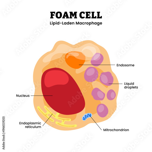 Foam cell anatomy structure diagram infographic, lipid laden macrophage with labeled endosome and lipid droplets, illustrating lipid accumulation and eukaryotic cells cellular atherosclerosis changes.