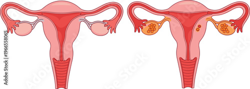 Female Reproductive System Anatomy Set Showing Healthy Uterus and Ovarian Conditions for Medical Diagnosis Healthcare Education and Gynecology Awareness Vector Illustrations