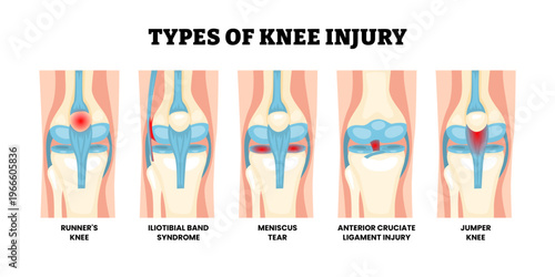 Different types of knee injury types. Labeled runners knee, iliotibial band syndrome, meniscus tear, anterior cruciate ligament injury, and jumper knee. Knee anatomy structure front view illustration.