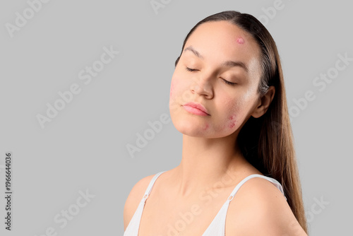 Young woman with acne probl...